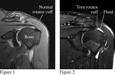 rotator tear